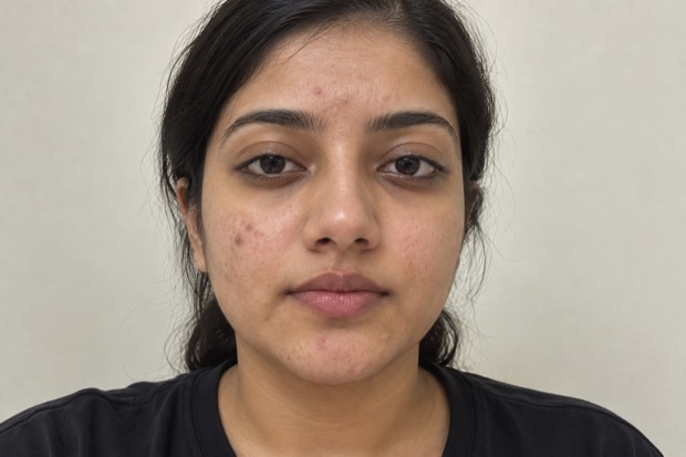Ishita M.'s skin before treatment