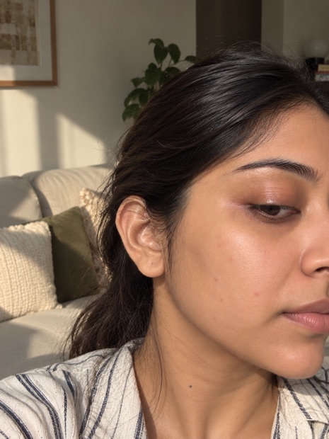 Meera J.'s skin after treatment