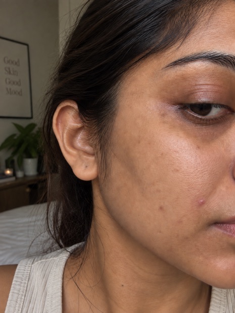 Meera J.'s skin before treatment
