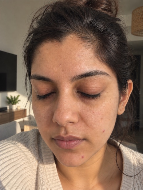 Meher T.'s skin after treatment