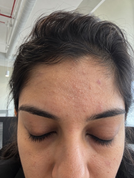 Meher T.'s skin before treatment