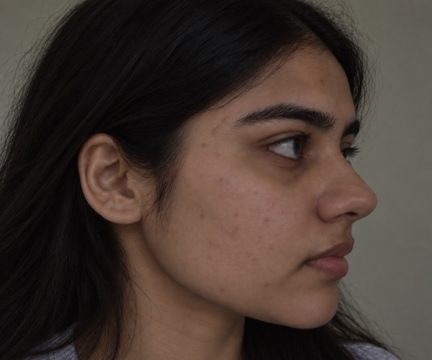 Neha S.'s skin after treatment