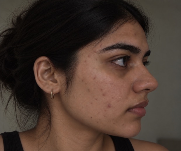 Neha S.'s skin before treatment