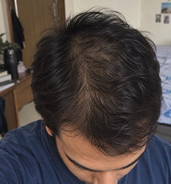 Rahul S.'s skin after treatment