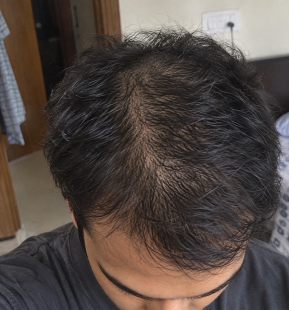 Rahul S.'s skin before treatment